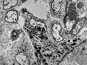 M,61y. | spleen - hemangioma v.s. … erythrophagocytosis